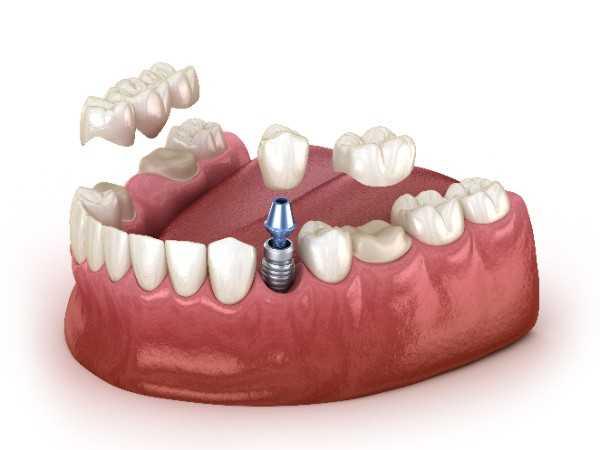 dental implants Putney